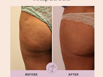 Enhance and lift your natural curves with a non-surgical approach