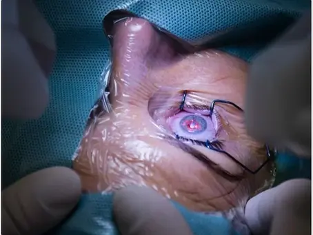 Cornea and Refractive Surgery Fellowship