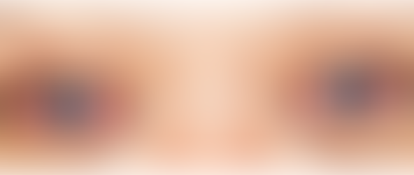 Relapsing polychondritis ear and nose