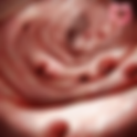 Diverticulosis/Diverticulitis: Causes, Symptoms, and Management