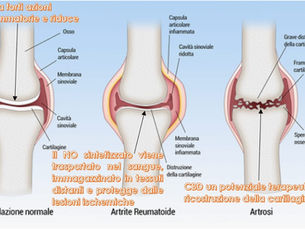 Artrite Reumatoide Autoimmune