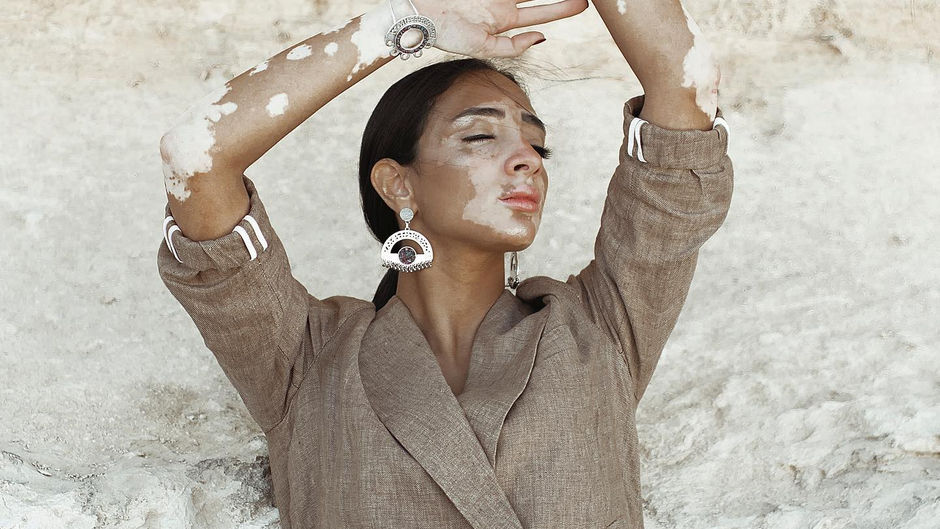 LOGINA SALAH PROVES THAT ‘VITILIGO IS JUST A COLOR’