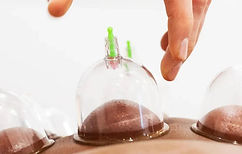 hijama_edited.jpg