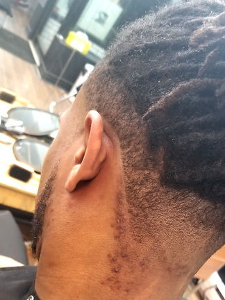 a model with ingrowns and scarring