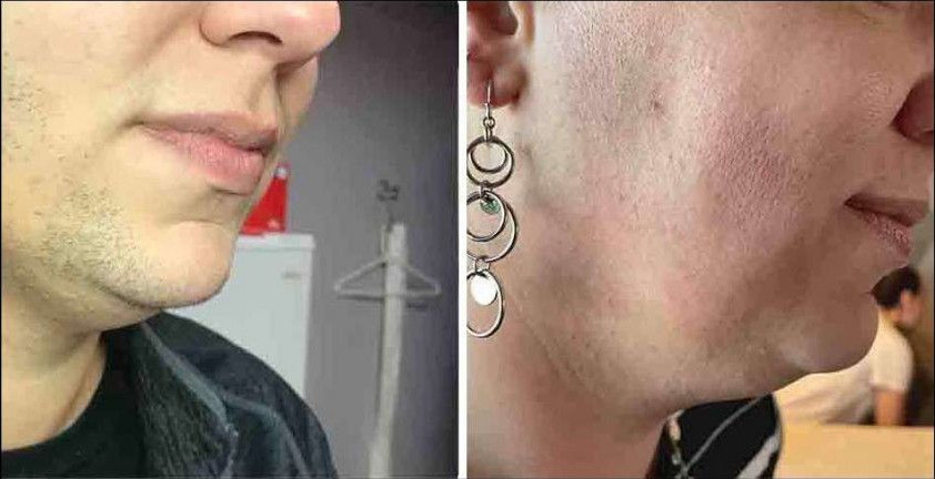 Before and after laser hair removal on a jaw and neck. Dark stubble in the first photo, smooth skin in the second.