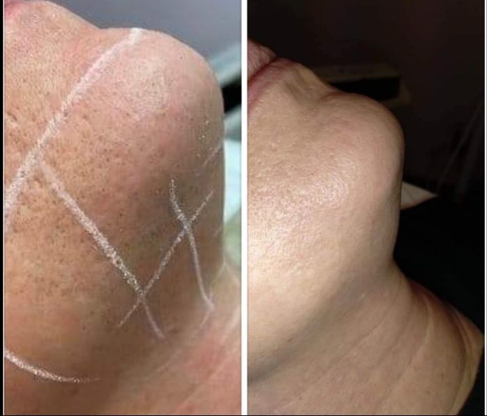 Before and after laser hair removal on a chin. Treatment grid lines marked on the skin in the first photo, smooth skin in the second.