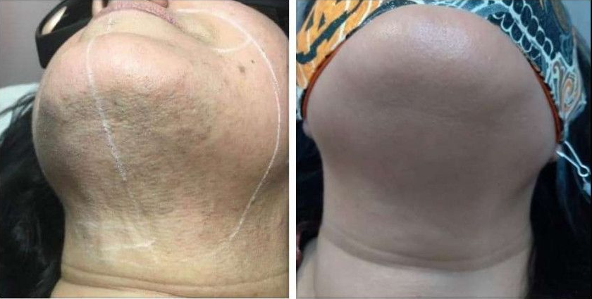 Before and after laser hair removal on a woman's chin and neck. Dark hair along the jaw in the first photo, smooth skin in the second.