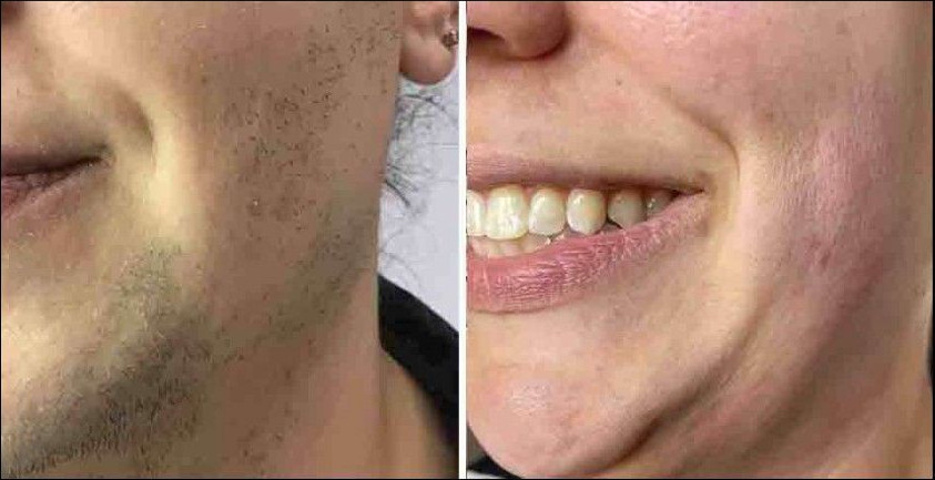 Before and after laser hair removal on a beard area. Heavy dark stubble in the first photo, smooth skin in the second.