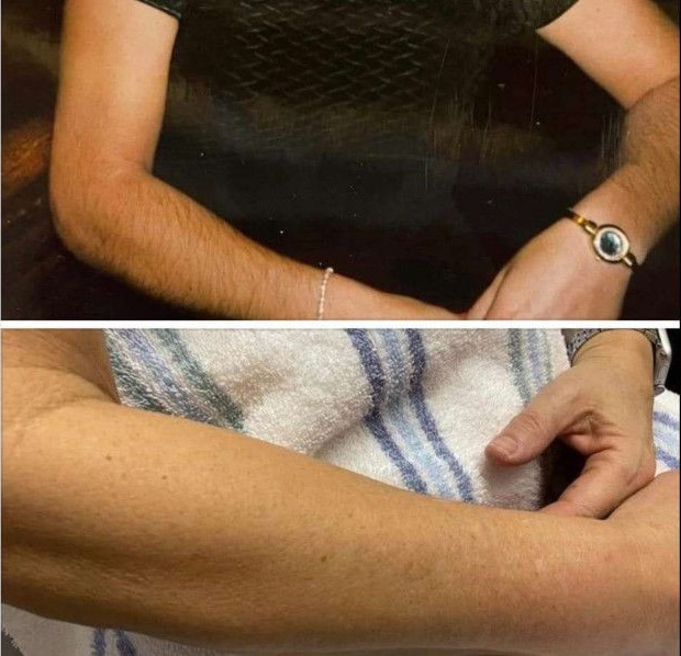 Before and after laser hair removal on a forearm. Dark hair in the first photo, smooth skin in the second.