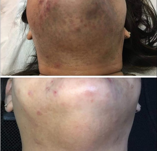Before and after laser hair removal on a chin and neck. Dark hair along the jaw in the first photo, clear skin with a little redness in the second.