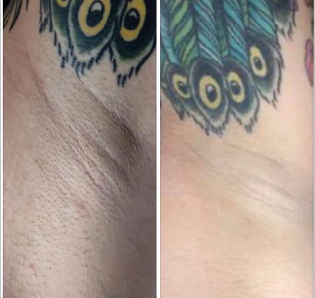 Before and after laser hair removal on an underarm beside a peacock feather tattoo. Dark hair in the first photo, clear skin in the second.