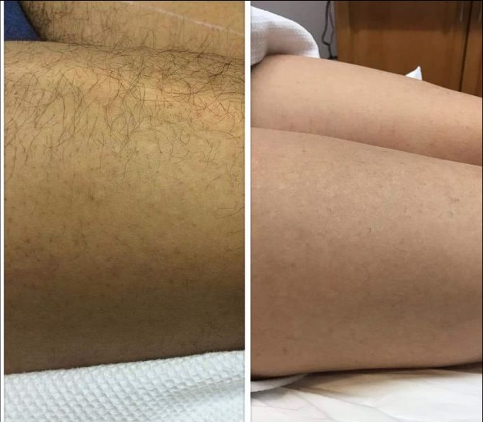 Before and after laser hair removal on a thigh. Dark hair in the first photo, smooth skin in the second.