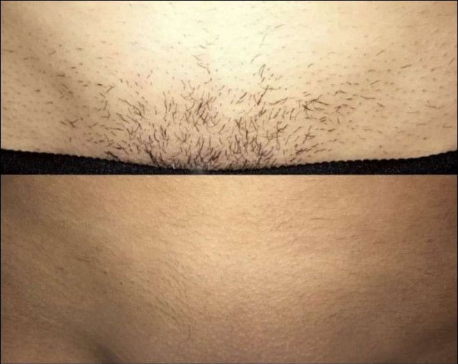 Before and after laser hair removal on the bikini line. Dark hair in the first photo, smooth skin in the second.