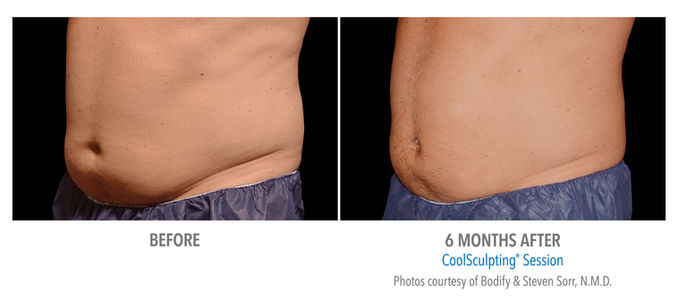 Coolsculpt East Cobb Buckhead