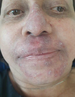 Herpes in its second phase