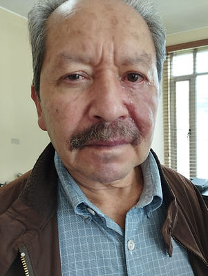 Herpes after finishing treatment