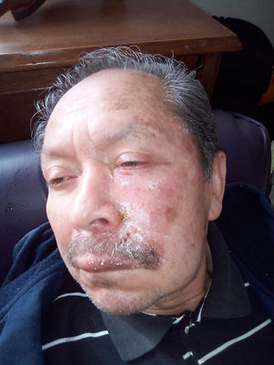 Herpes in its second phase