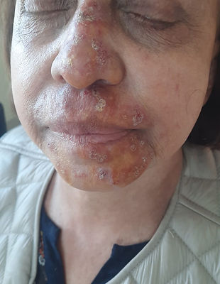 Herpes in its first phase