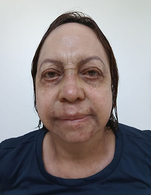 Herpes after finishing treatment