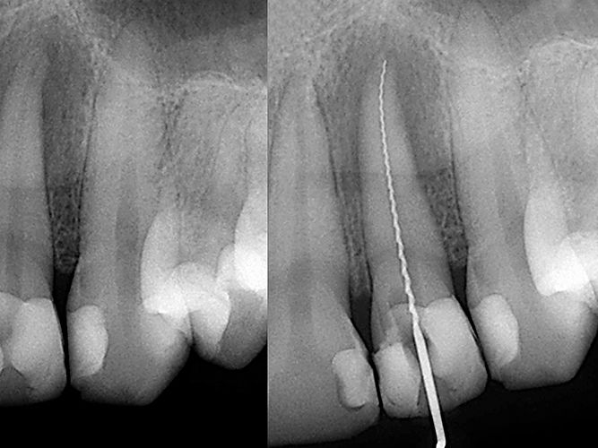 rootcanaltherapy_02.jpg