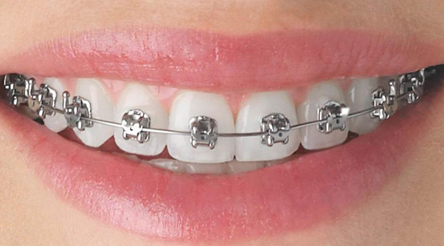 orthodontic-treatment-917x509.jpg