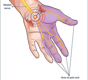 numbness-in-hands-treatment-kerala.jpg