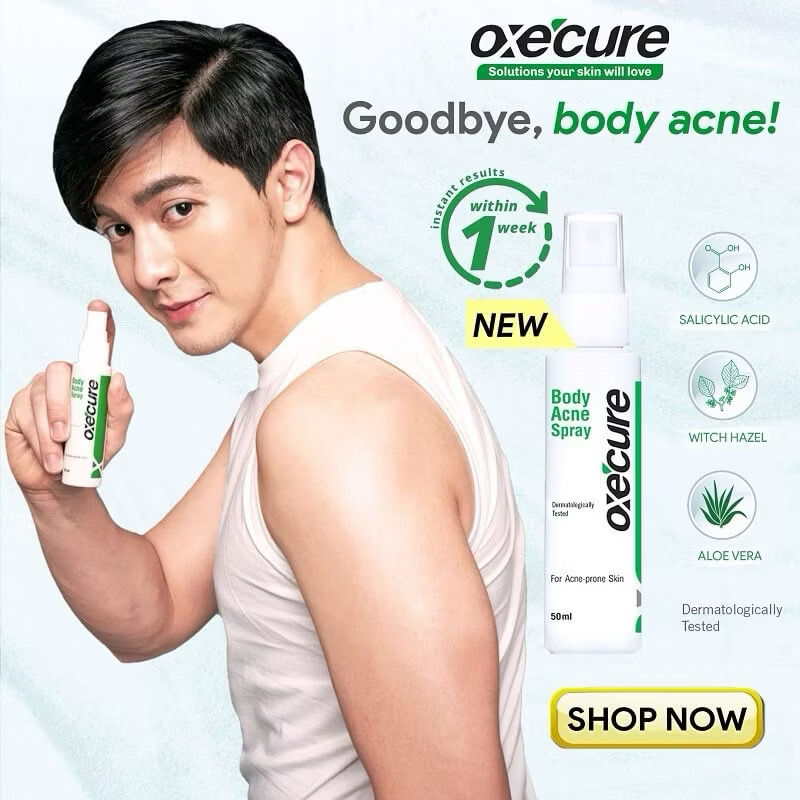Thumbnail: Oxe Cure Body Acne Spray
