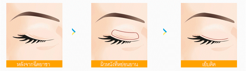 eyelid-06-03-2.gif