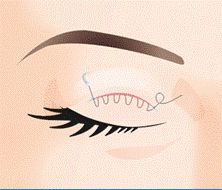eyelid-02-04.gif