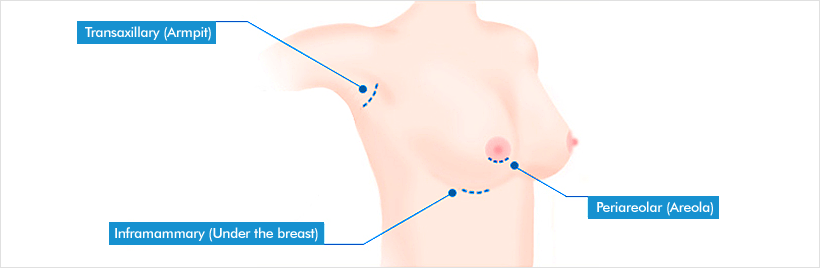 breast-02-03.gif