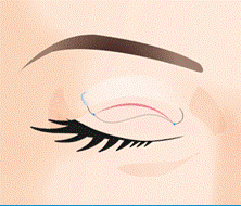 eyelid-02-02.gif