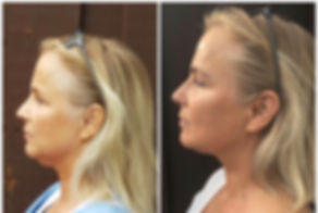 Lift, tighten, and tone your face naturally