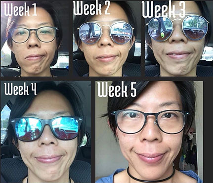 Correct your facial paralysis naturally with Face Yoga
