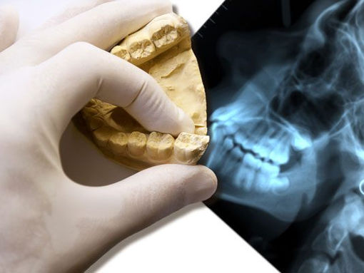 Wisdom Tooth Extraction Procedure