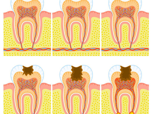 Stages of Tooth Decay: Which One Am I In?