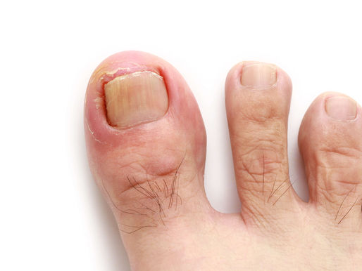 podiatre ongle incarne montreal