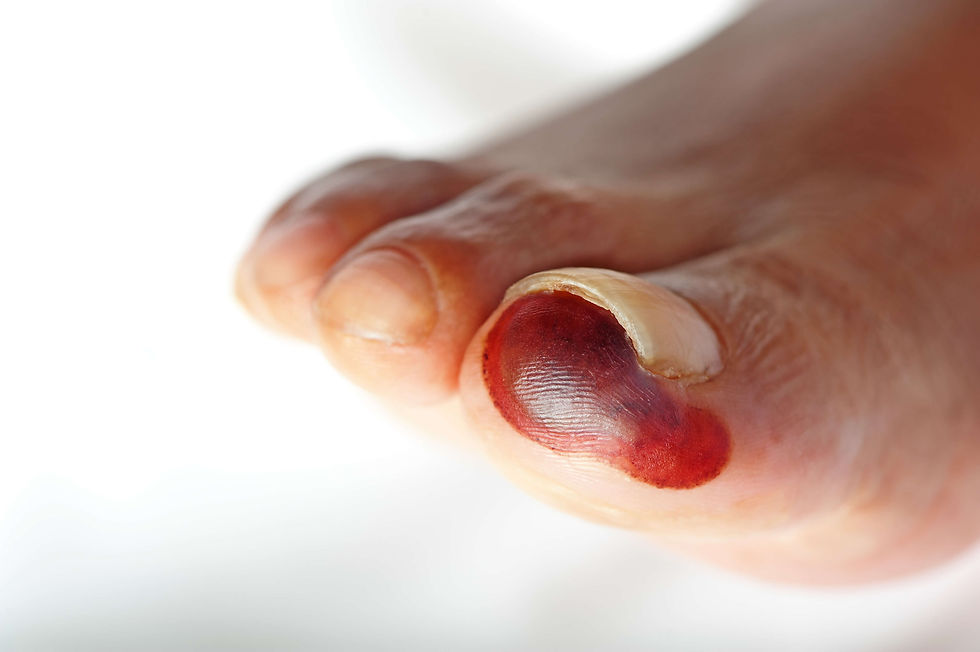 traitement-ulcere-diabetique-podiatre-montreal.jpeg