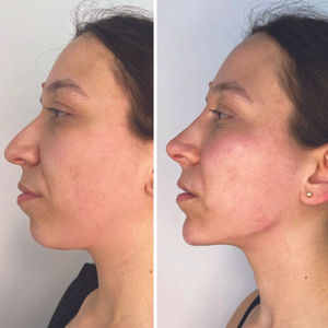 Endolift Treatment at NC Clinic Expert