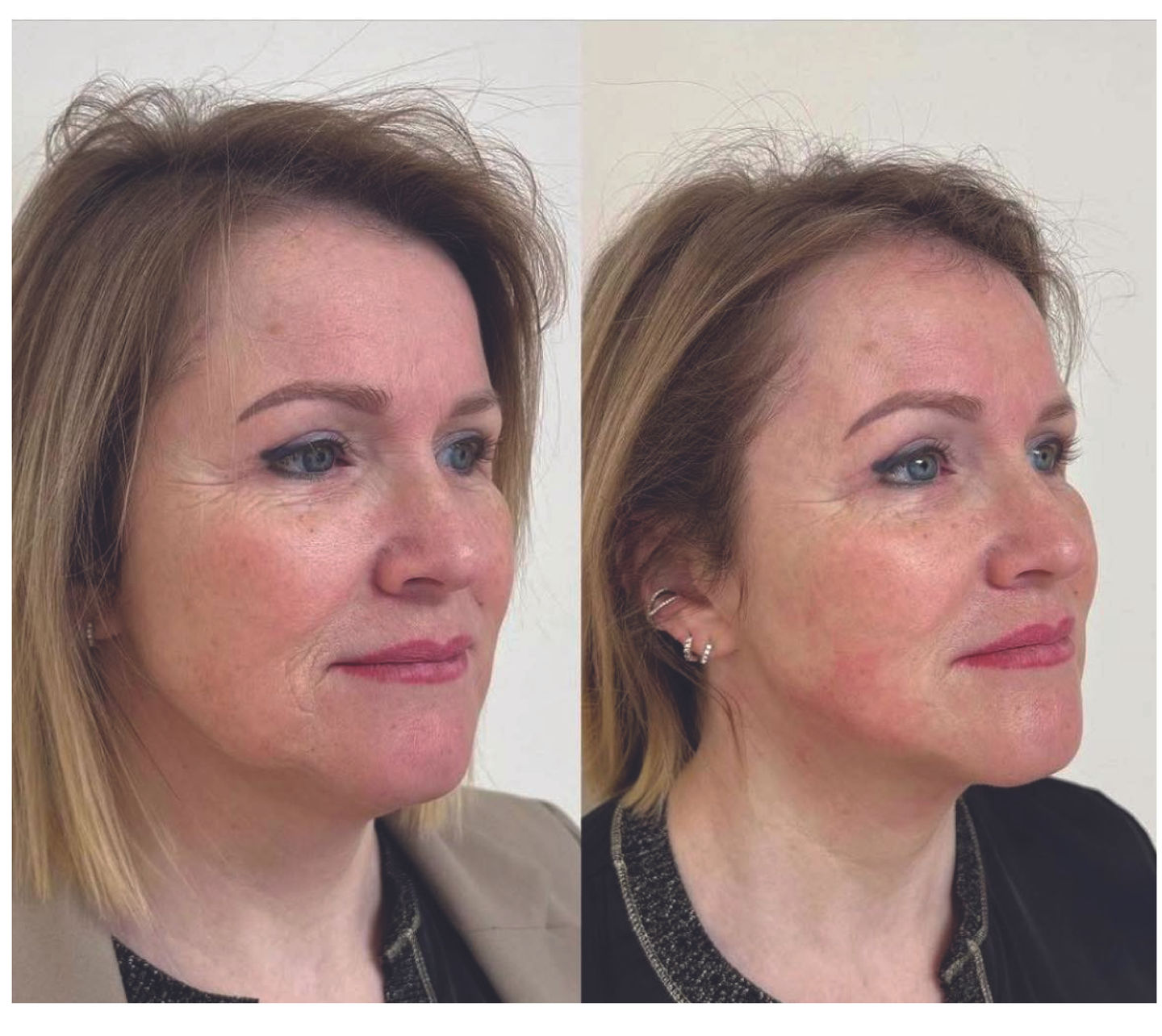 Endolift Treatment at NC Clinic Expert
