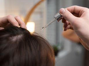 Minoxidil e queda de cabelo: por que o uso sem acompanhamento pode piorar o problema? Nos últimos anos, o minoxidil virou um dos produtos mais comentados quando o assunto é queda de cabelo. Basta pesquisar rapidamente nas redes sociais para encontrar promessas de crescimento acelerado dos fios, receitas prontas e pessoas indicando o medicamento como se ele fosse uma solução universal para qualquer tipo de queda capilar. Mas existe um problema importante nisso: nem toda queda de cabelo deve ser tratada com minoxidil. E, em alguns casos, o uso indiscriminado pode gerar mais frustração, piora da queda e atraso no diagnóstico correto. Uma das situações que mais assustam os pacientes é o chamado “shedding”, um aumento temporário da queda que pode acontecer após o início do tratamento com minoxidil. Quando bem indicado, esse processo pode fazer parte da resposta esperada do couro cabeludo. O medicamento acelera a renovação do ciclo capilar, fazendo com que fios que já estavam na fase final d