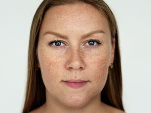 melasma dra julyanna dermatologista