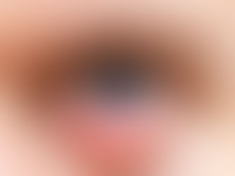 Chalazion and its treatment