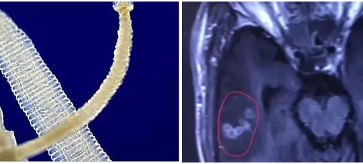 Penyebab Epilepsi Pria Ini Ternyata Ada Cacing Pita di Otaknya