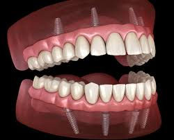 Understanding the Reality Behind 'Teeth in a Day' Implants Part 2 of 2