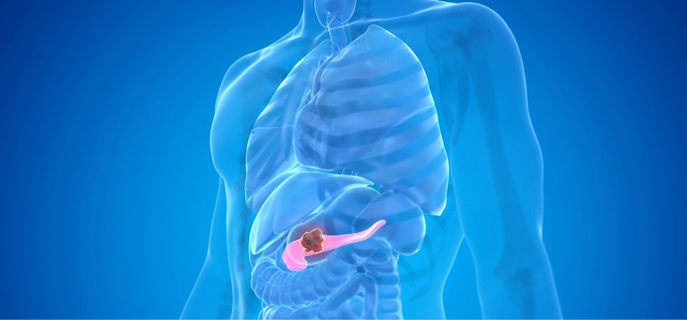 Pancreatic Cancer