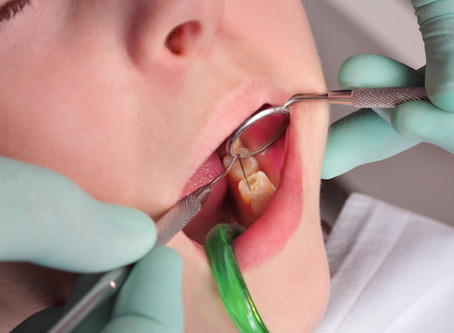 The Anatomy of a Cavity