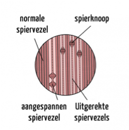 Triggerpunt spier | Myofasciaal pijnsyndroom