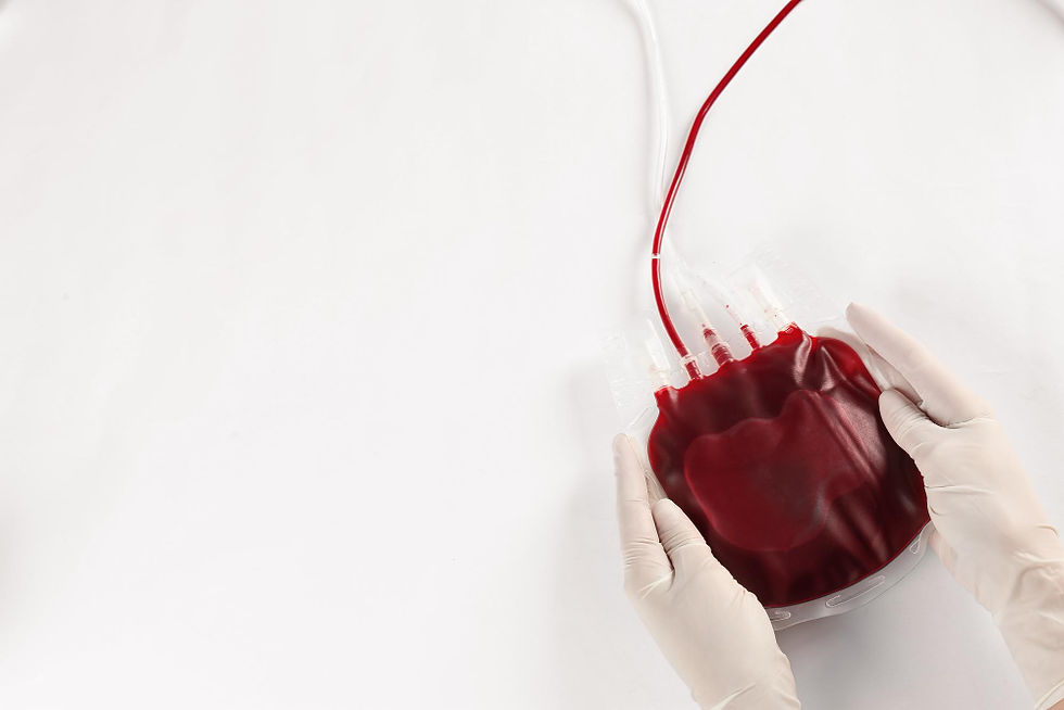 Blood bag prepared for transfusion.