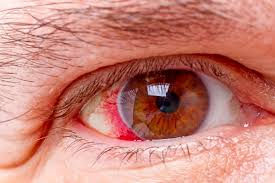 Glaucoma: A Doença Silenciosa que Pode Roubar Sua Visão