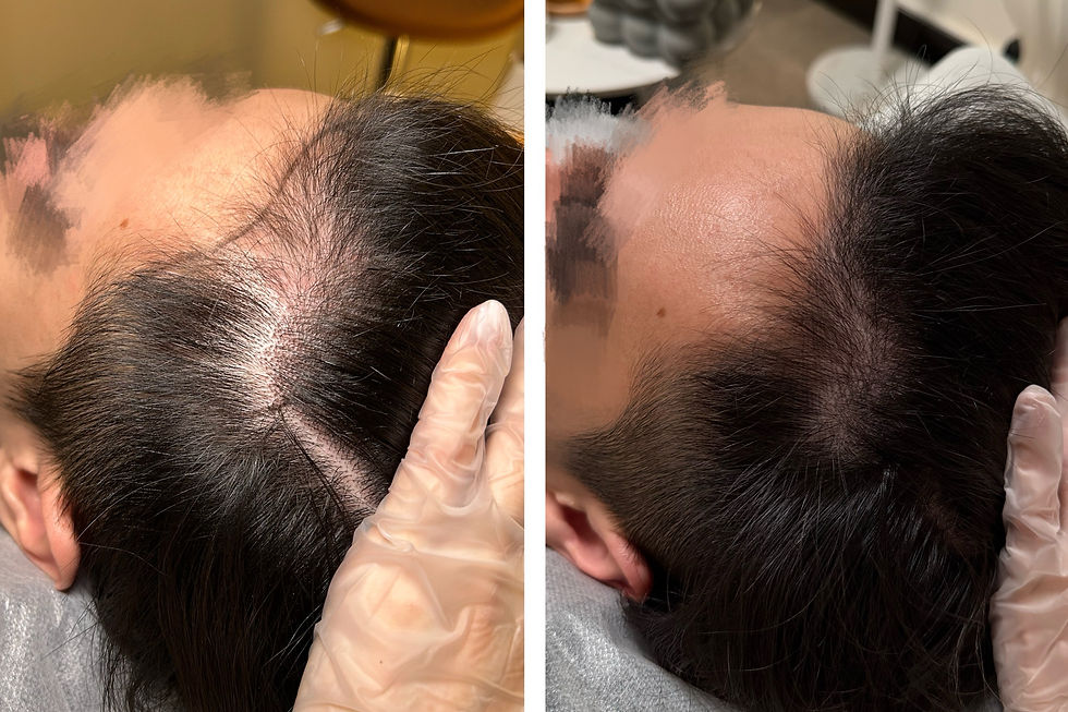 定點生髮(男士髮際線)